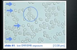 Analyse du sang d'un sujet faiblement exposé aux ondes électromagnétiques