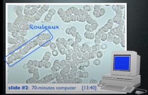 Sang du sujet exposé 70 mn devant son ordinateur